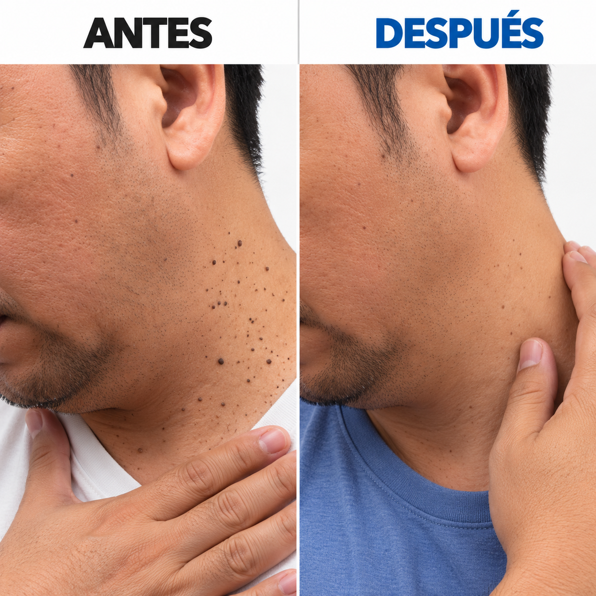 Removedor de verrugas sin dolor