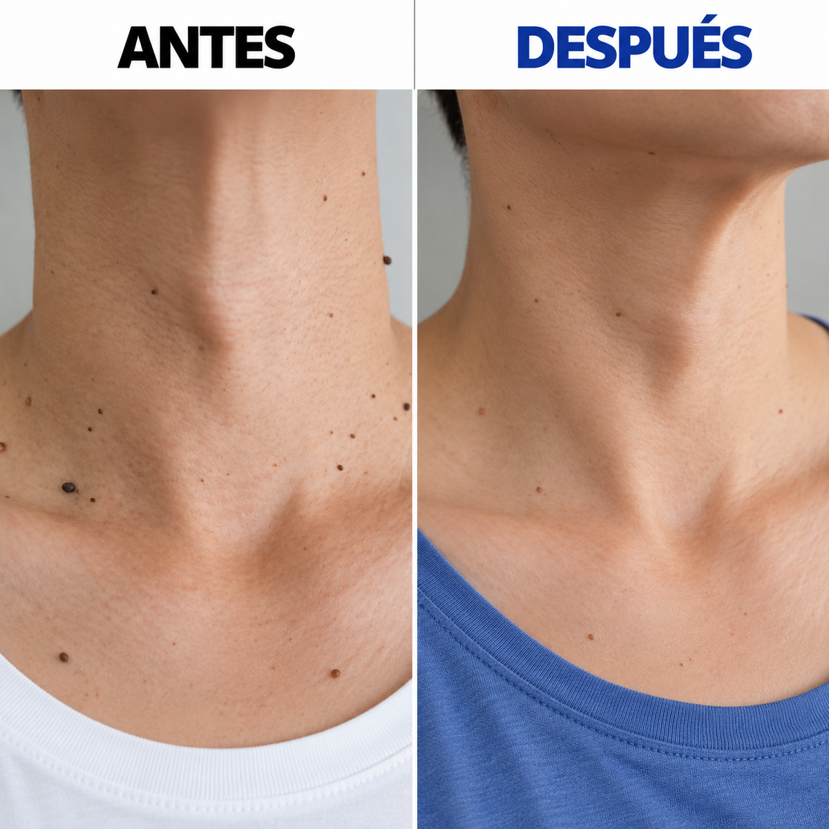 Removedor de verrugas sin dolor