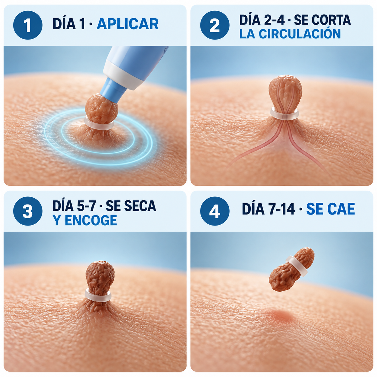Removedor de verrugas sin dolor