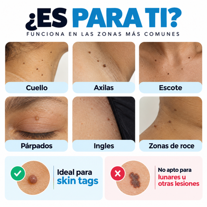 Removedor de verrugas sin dolor