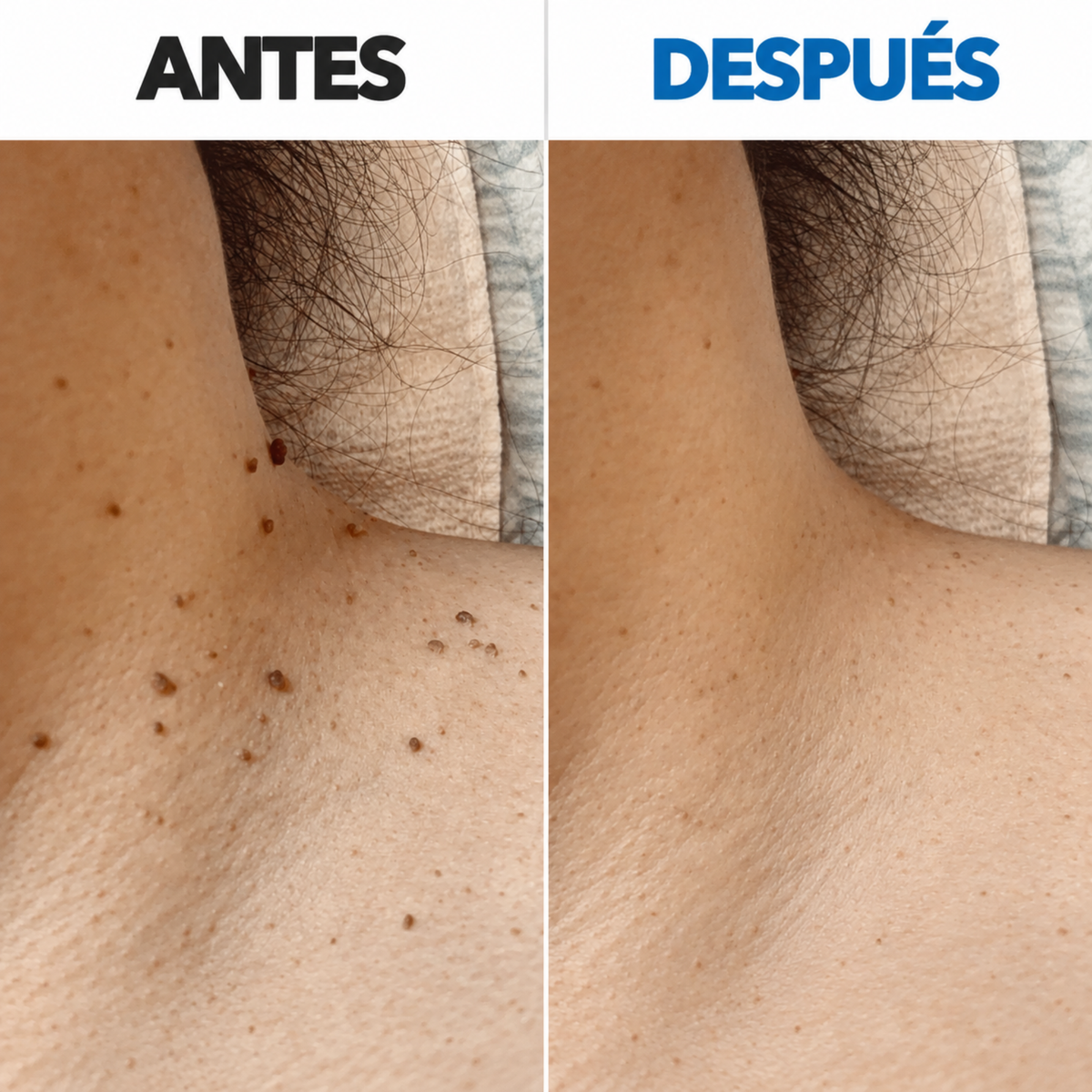 Removedor de verrugas sin dolor