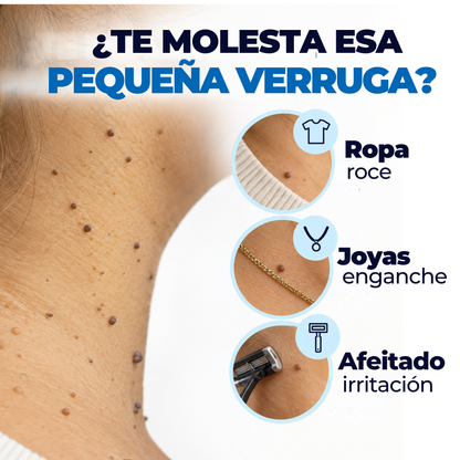 Removedor de verrugas sin dolor
